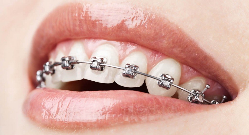Braces2