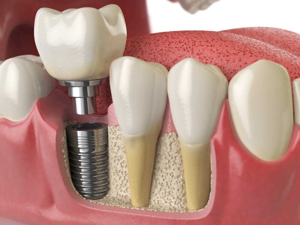 Crown & brdge work on implants